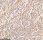 Immunohistochemical staining of SSSCA1/ZNRD2 using anti-ZNRD2 antibody. SSSCA1/ZNRD2 was detected in a paraffin-embedded section of human testicular seminoma tissue. Heat mediated antigen retrieval was performed in EDTA buffer (pH 8.0, epitope retrieval solution). The tissue section was blocked with 10% goat serum. The tissue section was then incubated with 2 ug/ml rabbit anti-ZNRD2 antibody overnight at 4oC. Peroxidase Conjugated Goat Anti-rabbit IgG was used as secondary antibody and incubated for 30 minutes at 37oC. The tissue section was developed using an HRP secondary and DAB substrate.