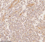 Immunohistochemical staining of SSSCA1/ZNRD2 using anti-ZNRD2 antibody. SSSCA1/ZNRD2 was detected in a paraffin-embedded section of human testicular seminoma tissue. Heat mediated antigen retrieval was performed in EDTA buffer (pH 8.0, epitope retrieval solution). The tissue section was blocked with 10% goat serum. The tissue section was then incubated with 2 ug/ml rabbit anti-ZNRD2 antibody overnight at 4oC. Peroxidase Conjugated Goat Anti-rabbit IgG was used as secondary antibody and incubated for 30 minutes at 37oC. The tissue section was developed using an HRP secondary and DAB substrate.