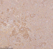 Immunohistochemical staining of SSSCA1/ZNRD2 using anti-ZNRD2 antibody. SSSCA1/ZNRD2 was detected in a paraffin-embedded section of human cervix squamous cell carcinoma tissue. Heat mediated antigen retrieval was performed in EDTA buffer (pH 8.0, epitope retrieval solution). The tissue section was blocked with 10% goat serum. The tissue section was then incubated with 2 ug/ml rabbit anti-ZNRD2 antibody overnight at 4oC. Peroxidase Conjugated Goat Anti-rabbit IgG was used as secondary antibody and incubated for 30 minutes at 37oC. The tissue section was developed using an HRP secondary and DAB substrate.