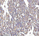 Immunohistochemical staining of GLOD5 using anti-GLOD5 antibody. GLOD5 was detected in a paraffin-embedded section of human stomach cancer tissue. Heat mediated antigen retrieval was performed in EDTA buffer (pH 8.0, epitope retrieval solution). The tissue section was blocked with 10% goat serum. The tissue section was then incubated with 2 ug/ml rabbit anti-GLOD5 antibody overnight at 4oC. Peroxidase Conjugated Goat Anti-rabbit IgG was used as secondary antibody and incubated for 30 minutes at 37oC. The tissue section was developed using an HRP secondary and DAB substrate.