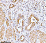 Immunohistochemical staining of SSH3 using anti-SSH3 antibody. SSH3 was detected in a paraffin-embedded section of human rectum adenocarcinoma tissue. Heat mediated antigen retrieval was performed in EDTA buffer (pH 8.0, epitope retrieval solution). The tissue section was blocked with 10% goat serum. The tissue section was then incubated with 2 ug/ml rabbit anti-SSH3 antibody overnight at 4oC. Peroxidase Conjugated Goat Anti-rabbit IgG was used as secondary antibody and incubated for 30 minutes at 37oC. The tissue section was developed using an HRP secondary and DAB substrate.