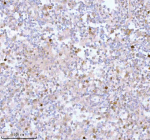 Immunohistochemical staining of SSH3 using anti-SSH3 antibody. SSH3 was detected in a paraffin-embedded section of human testicular seminoma tissue. Heat mediated antigen retrieval was performed in EDTA buffer (pH 8.0, epitope retrieval solution). The tissue section was blocked with 10% goat serum. The tissue section was then incubated with 2 ug/ml rabbit anti-SSH3 antibody overnight at 4oC. Peroxidase Conjugated Goat Anti-rabbit IgG was used as secondary antibody and incubated for 30 minutes at 37oC. The tissue section was developed using an HRP secondary and DAB substrate.