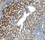 Immunohistochemical staining of GPNMB using anti-GPNMB antibody. GPNMB was detected in paraffin-embedded section of human liver cancer. Heat mediated antigen retrieval was performed in EDTA buffer (pH 8.0, epitope retrieval solution). The tissue section was blocked with 10% goat serum. The tissue section was then incubated with 1ug/ml rabbit anti-GPNMB antibody overnight at 4oC. Biotinylated goat anti-rabbit IgG was used as secondary antibody and incubated for 30 minutes at 37oC. The tissue section was developed using Strepavidin-Biotin-Complex (SABC) with DAB as the chromogen.