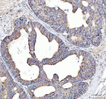 Immunohistochemical staining of SQRDL/SQOR using anti-SQOR antibody. SQRDL/SQOR was detected in a paraffin-embedded section of human colorectal adenocarcinoma tissue. Heat mediated antigen retrieval was performed in EDTA buffer (pH 8.0, epitope retrieval solution). The tissue section was blocked with 10% goat serum. The tissue section was then incubated with 2 ug/ml rabbit anti-SQOR antibody overnight at 4oC. Peroxidase Conjugated Goat Anti-rabbit IgG was used as secondary antibody and incubated for 30 minutes at 37oC. The tissue section was developed using an HRP secondary and DAB substrate.