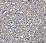 Immunohistochemical staining of SQRDL/SQOR using anti-SQOR antibody. SQRDL/SQOR was detected in a paraffin-embedded section of human liver cancer tissue. Heat mediated antigen retrieval was performed in EDTA buffer (pH 8.0, epitope retrieval solution). The tissue section was blocked with 10% goat serum. The tissue section was then incubated with 2 ug/ml rabbit anti-SQOR antibody overnight at 4oC. Peroxidase Conjugated Goat Anti-rabbit IgG was used as secondary antibody and incubated for 30 minutes at 37oC. The tissue section was developed using an HRP secondary and DAB substrate.