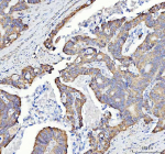 Immunohistochemical staining of SQRDL/SQOR using anti-SQOR antibody. SQRDL/SQOR was detected in a paraffin-embedded section of human lung adenocarcinoma tissue. Heat mediated antigen retrieval was performed in EDTA buffer (pH 8.0, epitope retrieval solution). The tissue section was blocked with 10% goat serum. The tissue section was then incubated with 2 ug/ml rabbit anti-SQOR antibody overnight at 4oC. Peroxidase Conjugated Goat Anti-rabbit IgG was used as secondary antibody and incubated for 30 minutes at 37oC. The tissue section was developed using an HRP secondary and DAB substrate.
