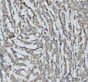 Immunohistochemical staining of SQRDL/SQOR using anti-SQOR antibody. SQRDL/SQOR was detected in a paraffin-embedded section of human breast cancer tissue. Heat mediated antigen retrieval was performed in EDTA buffer (pH 8.0, epitope retrieval solution). The tissue section was blocked with 10% goat serum. The tissue section was then incubated with 2 ug/ml rabbit anti-SQOR antibody overnight at 4oC. Peroxidase Conjugated Goat Anti-rabbit IgG was used as secondary antibody and incubated for 30 minutes at 37oC. The tissue section was developed using an HRP secondary and DAB substrate.