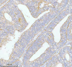 Immunohistochemical staining of PFKM using anti-PFKM antibody. PFKM was detected in a paraffin-embedded section of human endometrioid adenocarcinoma tissue. Heat mediated antigen retrieval was performed in EDTA buffer (pH 8.0, epitope retrieval solution). The tissue section was blocked with 10% goat serum. The tissue section was then incubated with 2 ug/ml rabbit anti-PFKM antibody overnight at 4oC. Peroxidase Conjugated Goat Anti-rabbit IgG was used as secondary antibody and incubated for 30 minutes at 37oC. The tissue section was developed using an HRP secondary and DAB substrate.