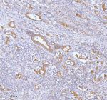 Immunohistochemical staining of PFKM using anti-PFKM antibody. PFKM was detected in a paraffin-embedded section of human rectum adenocarcinoma tissue. Heat mediated antigen retrieval was performed in EDTA buffer (pH 8.0, epitope retrieval solution). The tissue section was blocked with 10% goat serum. The tissue section was then incubated with 2 ug/ml rabbit anti-PFKM antibody overnight at 4oC. Peroxidase Conjugated Goat Anti-rabbit IgG was used as secondary antibody and incubated for 30 minutes at 37oC. The tissue section was developed using an HRP secondary and DAB substrate.