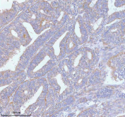 Immunohistochemical staining of PFKM using anti-PFKM antibody. PFKM was detected in a paraffin-embedded section of human endometrioid adenocarcinoma tissue. Heat mediated antigen retrieval was performed in EDTA buffer (pH 8.0, epitope retrieval solution). The tissue section was blocked with 10% goat serum. The tissue section was then incubated with 2 ug/ml rabbit anti-PFKM antibody overnight at 4oC. Peroxidase Conjugated Goat Anti-rabbit IgG was used as secondary antibody and incubated for 30 minutes at 37oC. The tissue section was developed using an HRP secondary and DAB substrate.