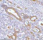 Immunohistochemical staining of PFKM using anti-PFKM antibody. PFKM was detected in a paraffin-embedded section of human rectum adenocarcinoma tissue. Heat mediated antigen retrieval was performed in EDTA buffer (pH 8.0, epitope retrieval solution). The tissue section was blocked with 10% goat serum. The tissue section was then incubated with 2 ug/ml rabbit anti-PFKM antibody overnight at 4oC. Peroxidase Conjugated Goat Anti-rabbit IgG was used as secondary antibody and incubated for 30 minutes at 37oC. The tissue section was developed using an HRP secondary and DAB substrate.