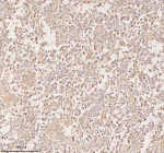 Immunohistochemical staining of PFKM using anti-PFKM antibody. PFKM was detected in a paraffin-embedded section of human testicular seminoma tissue. Heat mediated antigen retrieval was performed in EDTA buffer (pH 8.0, epitope retrieval solution). The tissue section was blocked with 10% goat serum. The tissue section was then incubated with 2 ug/ml rabbit anti-PFKM antibody overnight at 4oC. Peroxidase Conjugated Goat Anti-rabbit IgG was used as secondary antibody and incubated for 30 minutes at 37oC. The tissue section was developed using an HRP secondary and DAB substrate.
