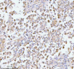 Immunohistochemical staining of PFKM using anti-PFKM antibody. PFKM was detected in a paraffin-embedded section of human testicular seminoma tissue. Heat mediated antigen retrieval was performed in EDTA buffer (pH 8.0, epitope retrieval solution). The tissue section was blocked with 10% goat serum. The tissue section was then incubated with 2 ug/ml rabbit anti-PFKM antibody overnight at 4oC. Peroxidase Conjugated Goat Anti-rabbit IgG was used as secondary antibody and incubated for 30 minutes at 37oC. The tissue section was developed using an HRP secondary and DAB substrate.