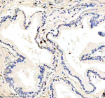 Immunohistochemical staining of IL21R using anti-IL21R antibody. IL21R was detected in a paraffin-embedded section of human prostate cancer tissue. Heat mediated antigen retrieval was performed in EDTA buffer (pH 8.0, epitope retrieval solution). The tissue section was blocked with 10% goat serum. The tissue section was then incubated with 2 ug/ml rabbit anti-IL21R antibody overnight at 4oC. Peroxidase Conjugated Goat Anti-rabbit IgG was used as secondary antibody and incubated for 30 minutes at 37oC. The tissue section was developed using an HRP secondary and DAB substrate.