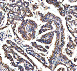 Immunohistochemical staining of RASAL3 using anti-RASAL3 antibody. RASAL3 was detected in a paraffin-embedded section of human lung cancer tissue. Heat mediated antigen retrieval was performed in EDTA buffer (pH 8.0, epitope retrieval solution). The tissue section was blocked with 10% goat serum. The tissue section was then incubated with 2 ug/ml rabbit anti-RASAL3 antibody overnight at 4oC. Peroxidase Conjugated Goat Anti-rabbit IgG was used as secondary antibody and incubated for 30 minutes at 37oC. The tissue section was developed using an HRP secondary and DAB substrate.