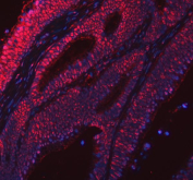 Immunofluorescent staining of FFPE human colorectal cancer tissue with RSRC2 antibody (red) and DAPI nuclear stain (blue). HIER: steam section in pH8 EDTA buffer for 20 min.