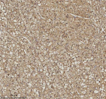 Immunohistochemical staining of RSRC2 using anti-RSRC2 antibody. RSRC2 was detected in a paraffin-embedded section of human adrenocortical adenoma tissue. Heat mediated antigen retrieval was performed in EDTA buffer (pH 8.0, epitope retrieval solution). The tissue section was blocked with 10% goat serum. The tissue section was then incubated with 2 ug/ml rabbit anti-RSRC2 antibody overnight at 4oC. Peroxidase Conjugated Goat Anti-rabbit IgG was used as secondary antibody and incubated for 30 minutes at 37oC. The tissue section was developed using an HRP secondary and DAB substrate.