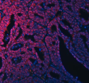 Immunofluorescent staining of FFPE human ovarian cancer tissue with RSRC2 antibody (red) and DAPI nuclear stain (blue). HIER: steam section in pH8 EDTA buffer for 20 min.