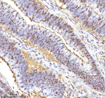 Immunohistochemical staining of RSRC2 using anti-RSRC2 antibody. RSRC2 was detected in a paraffin-embedded section of human colon adenocarcinoma tissue. Heat mediated antigen retrieval was performed in EDTA buffer (pH 8.0, epitope retrieval solution). The tissue section was blocked with 10% goat serum. The tissue section was then incubated with 2 ug/ml rabbit anti-RSRC2 antibody overnight at 4oC. Peroxidase Conjugated Goat Anti-rabbit IgG was used as secondary antibody and incubated for 30 minutes at 37oC. The tissue section was developed using an HRP secondary and DAB substrate.