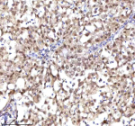 Immunohistochemical staining of RSRC2 using anti-RSRC2 antibody. RSRC2 was detected in a paraffin-embedded section of human ovary serous carcinoma tissue. Heat mediated antigen retrieval was performed in EDTA buffer (pH 8.0, epitope retrieval solution). The tissue section was blocked with 10% goat serum. The tissue section was then incubated with 2 ug/ml rabbit anti-RSRC2 antibody overnight at 4oC. Peroxidase Conjugated Goat Anti-rabbit IgG was used as secondary antibody and incubated for 30 minutes at 37oC. The tissue section was developed using an HRP secondary and DAB substrate.