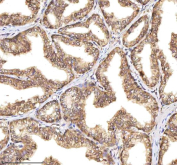 Immunohistochemical staining of RSRC2 using anti-RSRC2 antibody. RSRC2 was detected in a paraffin-embedded section of human prostate adenocarcinoma tissue. Heat mediated antigen retrieval was performed in EDTA buffer (pH 8.0, epitope retrieval solution). The tissue section was blocked with 10% goat serum. The tissue section was then incubated with 2 ug/ml rabbit anti-RSRC2 antibody overnight at 4oC. Peroxidase Conjugated Goat Anti-rabbit IgG was used as secondary antibody and incubated for 30 minutes at 37oC. The tissue section was developed using an HRP secondary and DAB substrate.