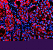 Immunofluorescent staining of P4HA1 using anti-P4HA1 antibody (red). P4HA1 was detected in a paraffin-embedded section of human liver cancer tissue. Heat mediated antigen retrieval was performed in EDTA buffer (pH 8.0, epitope retrieval solution). The tissue section was blocked with 10% goat serum. The tissue section was then incubated with 5 ug/ml rabbit anti-P4HA1 antibody overnight at 4oC. Cy3 Conjugated Goat Anti-Rabbit IgG was used as secondary antibody at 1:500 dilution and incubated for 30 minutes at 37oC. The section was counterstained with DAPI nuclear stain (blue). Visualize using a fluorescence microscope and filter sets appropriate for the label used.