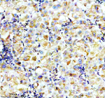 Immunohistochemical staining of P4HA1 using anti-P4HA1 antibody. P4HA1 was detected in a paraffin-embedded section of human liver cancer tissue. Heat mediated antigen retrieval was performed in EDTA buffer (pH 8.0, epitope retrieval solution). The tissue section was blocked with 10% goat serum. The tissue section was then incubated with 2 ug/ml rabbit anti-P4HA1 antibody overnight at 4oC. Peroxidase Conjugated Goat Anti-rabbit IgG was used as secondary antibody and incubated for 30 minutes at 37oC. The tissue section was developed using an HRP secondary and DAB substrate.