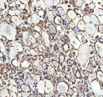 Immunohistochemical staining of CYP26B1 using anti-CYP26B1 antibody. CYP26B1 was detected in a paraffin-embedded section of human thyroid cancer tissue. Heat mediated antigen retrieval was performed in EDTA buffer (pH 8.0, epitope retrieval solution). The tissue section was blocked with 10% goat serum. The tissue section was then incubated with 2 ug/ml rabbit anti-CYP26B1 antibody overnight at 4oC. Peroxidase Conjugated Goat Anti-rabbit IgG was used as secondary antibody and incubated for 30 minutes at 37oC. The tissue section was developed using an HRP secondary and DAB substrate.