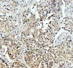 Immunohistochemical staining of TAF3 using anti-TAF3 antibody. TAF3 was detected in a paraffin-embedded section of human lung cancer tissue. Heat mediated antigen retrieval was performed in EDTA buffer (pH 8.0, epitope retrieval solution). The tissue section was blocked with 10% goat serum. The tissue section was then incubated with 2 ug/ml rabbit anti-TAF3 antibody overnight at 4oC. Peroxidase Conjugated Goat Anti-rabbit IgG was used as secondary antibody and incubated for 30 minutes at 37oC. The tissue section was developed using an HRP secondary and DAB substrate.