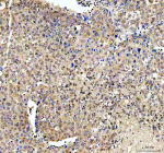 Immunohistochemical staining of TAF3 using anti-TAF3 antibody. TAF3 was detected in a paraffin-embedded section of human liver cancer tissue. Heat mediated antigen retrieval was performed in EDTA buffer (pH 8.0, epitope retrieval solution). The tissue section was blocked with 10% goat serum. The tissue section was then incubated with 2 ug/ml rabbit anti-TAF3 antibody overnight at 4oC. Peroxidase Conjugated Goat Anti-rabbit IgG was used as secondary antibody and incubated for 30 minutes at 37oC. The tissue section was developed using an HRP secondary and DAB substrate.
