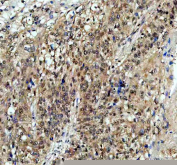 Immunohistochemical staining of TAF3 using anti-TAF3 antibody. TAF3 was detected in a paraffin-embedded section of human ovarian cancer tissue. Heat mediated antigen retrieval was performed in EDTA buffer (pH 8.0, epitope retrieval solution). The tissue section was blocked with 10% goat serum. The tissue section was then incubated with 2 ug/ml rabbit anti-TAF3 antibody overnight at 4oC. Peroxidase Conjugated Goat Anti-rabbit IgG was used as secondary antibody and incubated for 30 minutes at 37oC. The tissue section was developed using an HRP secondary and DAB substrate.