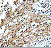 Immunohistochemical staining of TAF3 using anti-TAF3 antibody. TAF3 was detected in a paraffin-embedded section of human bladder cancer tissue. Heat mediated antigen retrieval was performed in EDTA buffer (pH 8.0, epitope retrieval solution). The tissue section was blocked with 10% goat serum. The tissue section was then incubated with 2 ug/ml rabbit anti-TAF3 antibody overnight at 4oC. Peroxidase Conjugated Goat Anti-rabbit IgG was used as secondary antibody and incubated for 30 minutes at 37oC. The tissue section was developed using an HRP secondary and DAB substrate.
