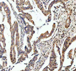Immunohistochemical staining of TAF3 using anti-TAF3 antibody. TAF3 was detected in a paraffin-embedded section of human colon cancer tissue. Heat mediated antigen retrieval was performed in EDTA buffer (pH 8.0, epitope retrieval solution). The tissue section was blocked with 10% goat serum. The tissue section was then incubated with 2 ug/ml rabbit anti-TAF3 antibody overnight at 4oC. Peroxidase Conjugated Goat Anti-rabbit IgG was used as secondary antibody and incubated for 30 minutes at 37oC. The tissue section was developed using an HRP secondary and DAB substrate.