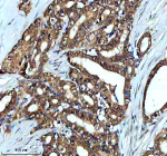 Immunohistochemical staining of TAF3 using anti-TAF3 antibody. TAF3 was detected in a paraffin-embedded section of human thyroid cancer tissue. Heat mediated antigen retrieval was performed in EDTA buffer (pH 8.0, epitope retrieval solution). The tissue section was blocked with 10% goat serum. The tissue section was then incubated with 2 ug/ml rabbit anti-TAF3 antibody overnight at 4oC. Peroxidase Conjugated Goat Anti-rabbit IgG was used as secondary antibody and incubated for 30 minutes at 37oC. The tissue section was developed using an HRP secondary and DAB substrate.