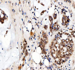 Immunohistochemical staining of TAF3 using anti-TAF3 antibody. TAF3 was detected in a paraffin-embedded section of human breast cancer tissue. Heat mediated antigen retrieval was performed in EDTA buffer (pH 8.0, epitope retrieval solution). The tissue section was blocked with 10% goat serum. The tissue section was then incubated with 2 ug/ml rabbit anti-TAF3 antibody overnight at 4oC. Peroxidase Conjugated Goat Anti-rabbit IgG was used as secondary antibody and incubated for 30 minutes at 37oC. The tissue section was developed using an HRP secondary and DAB substrate.