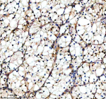 Immunohistochemical staining of TAF3 using anti-TAF3 antibody. TAF3 was detected in a paraffin-embedded section of human renal cancer tissue. Heat mediated antigen retrieval was performed in EDTA buffer (pH 8.0, epitope retrieval solution). The tissue section was blocked with 10% goat serum. The tissue section was then incubated with 2 ug/ml rabbit anti-TAF3 antibody overnight at 4oC. Peroxidase Conjugated Goat Anti-rabbit IgG was used as secondary antibody and incubated for 30 minutes at 37oC. The tissue section was developed using an HRP secondary and DAB substrate.