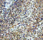 Immunohistochemical staining of TAF3 using anti-TAF3 antibody. TAF3 was detected in a paraffin-embedded section of human cervical cancer tissue. Heat mediated antigen retrieval was performed in EDTA buffer (pH 8.0, epitope retrieval solution). The tissue section was blocked with 10% goat serum. The tissue section was then incubated with 2 ug/ml rabbit anti-TAF3 antibody overnight at 4oC. Peroxidase Conjugated Goat Anti-rabbit IgG was used as secondary antibody and incubated for 30 minutes at 37oC. The tissue section was developed using an HRP secondary and DAB substrate.