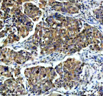 Immunohistochemical staining of TAF3 using anti-TAF3 antibody. TAF3 was detected in a paraffin-embedded section of human ovarian cancer tissue. Heat mediated antigen retrieval was performed in EDTA buffer (pH 8.0, epitope retrieval solution). The tissue section was blocked with 10% goat serum. The tissue section was then incubated with 2 ug/ml rabbit anti-TAF3 antibody overnight at 4oC. Peroxidase Conjugated Goat Anti-rabbit IgG was used as secondary antibody and incubated for 30 minutes at 37oC. The tissue section was developed using an HRP secondary and DAB substrate.