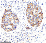 Immunohistochemical staining of LRG1 using anti-LRG1 antibody. LRG1 was detected in a paraffin-embedded section of human pancreas cancer tissue. Heat mediated antigen retrieval was performed in EDTA buffer (pH 8.0, epitope retrieval solution). The tissue section was blocked with 10% goat serum. The tissue section was then incubated with 1:100 rabbit anti-LRG1 antibody overnight at 4oC. Peroxidase Conjugated Goat Anti-rabbit IgG was used as secondary antibody and incubated for 30 minutes at 37oC. The tissue section was developed using an HRP secondary and DAB substrate.