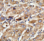 Immunohistochemical staining of LRG1 using anti-LRG1 antibody. LRG1 was detected in a paraffin-embedded section of human liver cancer tissue. Heat mediated antigen retrieval was performed in EDTA buffer (pH 8.0, epitope retrieval solution). The tissue section was blocked with 10% goat serum. The tissue section was then incubated with 2 ug/ml rabbit anti-LRG1 antibody overnight at 4oC. Peroxidase Conjugated Goat Anti-rabbit IgG was used as secondary antibody and incubated for 30 minutes at 37oC. The tissue section was developed using an HRP secondary and DAB substrate.