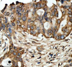 Immunohistochemical staining of LRG1 using anti-LRG1 antibody. LRG1 was detected in a paraffin-embedded section of human pancreas cancer tissue. Heat mediated antigen retrieval was performed in EDTA buffer (pH 8.0, epitope retrieval solution). The tissue section was blocked with 10% goat serum. The tissue section was then incubated with 2 ug/ml rabbit anti-LRG1 antibody overnight at 4oC. Peroxidase Conjugated Goat Anti-rabbit IgG was used as secondary antibody and incubated for 30 minutes at 37oC. The tissue section was developed using an HRP secondary and DAB substrate.