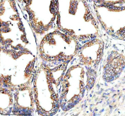 Immunohistochemical staining of NAA60 using anti-NAA60 antibody. NAA60 was detected in a paraffin-embedded section of human prostate cancer tissue. Heat mediated antigen retrieval was performed in EDTA buffer (pH 8.0, epitope retrieval solution). The tissue section was blocked with 10% goat serum. The tissue section was then incubated with 2 ug/ml rabbit anti-NAA60 antibody overnight at 4oC. Peroxidase Conjugated Goat Anti-rabbit IgG was used as secondary antibody and incubated for 30 minutes at 37oC. The tissue section was developed using an HRP secondary and DAB substrate.