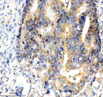 Immunohistochemical staining of FBXO7 using anti-FBXO7 antibody. FBXO7 was detected in a paraffin-embedded section of human colon cancer tissue. Heat mediated antigen retrieval was performed in EDTA buffer (pH 8.0, epitope retrieval solution). The tissue section was blocked with 10% goat serum. The tissue section was then incubated with 2 ug/ml rabbit anti-FBXO7 antibody overnight at 4oC. Peroxidase Conjugated Goat Anti-rabbit IgG was used as secondary antibody and incubated for 30 minutes at 37oC. The tissue section was developed using an HRP secondary and DAB substrate.