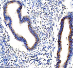 Immunohistochemical staining of FBXO7 using anti-FBXO7 antibody. FBXO7 was detected in a paraffin-embedded section of human endometrial cancer tissue. Heat mediated antigen retrieval was performed in EDTA buffer (pH 8.0, epitope retrieval solution). The tissue section was blocked with 10% goat serum. The tissue section was then incubated with 2 ug/ml rabbit anti-FBXO7 antibody overnight at 4oC. Peroxidase Conjugated Goat Anti-rabbit IgG was used as secondary antibody and incubated for 30 minutes at 37oC. The tissue section was developed using an HRP secondary and DAB substrate.