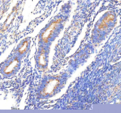 Immunohistochemical staining of CLTB using anti-CLTB antibody. CLTB was detected in a paraffin-embedded section of human endometrial cancer tissue. Heat mediated antigen retrieval was performed in EDTA buffer (pH 8.0, epitope retrieval solution). The tissue section was blocked with 10% goat serum. The tissue section was then incubated with 2 ug/ml rabbit anti-CLTB antibody overnight at 4oC. Peroxidase Conjugated Goat Anti-rabbit IgG was used as secondary antibody and incubated for 30 minutes at 37oC. The tissue section was developed using an HRP secondary and DAB substrate.