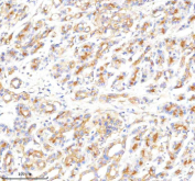 Immunohistochemical staining of CLTB using anti-CLTB antibody. CLTB was detected in a paraffin-embedded section of human pancreas cancer tissue. Heat mediated antigen retrieval was performed in EDTA buffer (pH 8.0, epitope retrieval solution). The tissue section was blocked with 10% goat serum. The tissue section was then incubated with 2 ug/ml rabbit anti-CLTB antibody overnight at 4oC. Peroxidase Conjugated Goat Anti-rabbit IgG was used as secondary antibody and incubated for 30 minutes at 37oC. The tissue section was developed using an HRP secondary and DAB substrate.