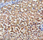 Immunohistochemical staining of TIM10/TIMM10 using anti-TIMM10 antibody. TIM10/TIMM10 was detected in a paraffin-embedded section of human liver tissue. Heat mediated antigen retrieval was performed in EDTA buffer (pH 8.0, epitope retrieval solution). The tissue section was blocked with 10% goat serum. The tissue section was then incubated with 2 ug/ml rabbit anti-TIMM10 antibody overnight at 4oC. Peroxidase Conjugated Goat Anti-rabbit IgG was used as secondary antibody and incubated for 30 minutes at 37oC. The tissue section was developed using an HRP secondary and DAB substrate.