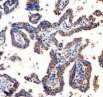 Immunohistochemical staining of TIM10/TIMM10 using anti-TIMM10 antibody. TIM10/TIMM10 was detected in a paraffin-embedded section of human lung cancer tissue. Heat mediated antigen retrieval was performed in EDTA buffer (pH 8.0, epitope retrieval solution). The tissue section was blocked with 10% goat serum. The tissue section was then incubated with 2 ug/ml rabbit anti-TIMM10 antibody overnight at 4oC. Peroxidase Conjugated Goat Anti-rabbit IgG was used as secondary antibody and incubated for 30 minutes at 37oC. The tissue section was developed using an HRP secondary and DAB substrate.