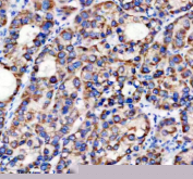 Immunohistochemical staining of TIM10/TIMM10 using anti-TIMM10 antibody. TIM10/TIMM10 was detected in a paraffin-embedded section of human liver cancer tissue. Heat mediated antigen retrieval was performed in EDTA buffer (pH 8.0, epitope retrieval solution). The tissue section was blocked with 10% goat serum. The tissue section was then incubated with 2 ug/ml rabbit anti-TIMM10 antibody overnight at 4oC. Peroxidase Conjugated Goat Anti-rabbit IgG was used as secondary antibody and incubated for 30 minutes at 37oC. The tissue section was developed using an HRP secondary and DAB substrate.