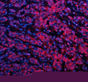 Immunofluorescent staining of GSTK1 using anti-GSTK1 antibody (red). GSTK1 was detected in a paraffin-embedded section of human breast cancer tissue. Heat mediated antigen retrieval was performed in EDTA buffer (pH 8.0, epitope retrieval solution). The tissue section was blocked with 10% goat serum. The tissue section was then incubated with 5 ug/ml rabbit anti-GSTK1 antibody overnight at 4oC. Cy3 Conjugated Goat Anti-Rabbit IgG was used as secondary antibody at 1:500 dilution and incubated for 30 minutes at 37oC. The section was counterstained with DAPI nuclear stain (blue). Visualize using a fluorescence microscope and filter sets appropriate for the label used.